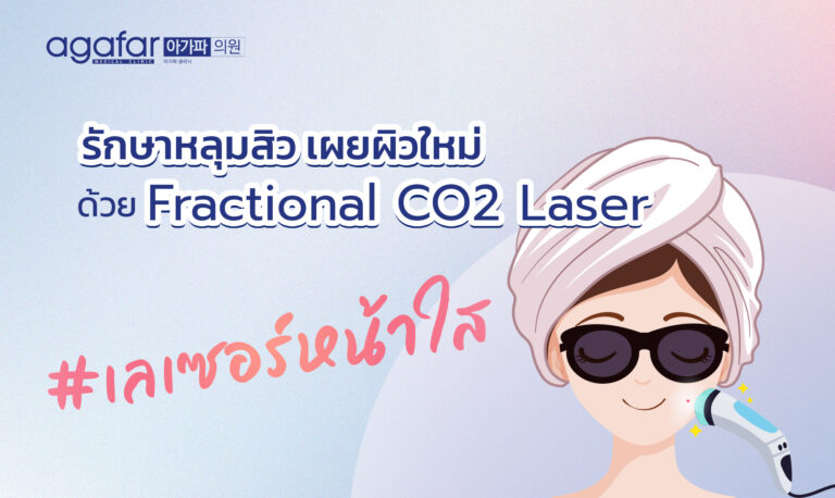 รักษาหลุมสิว เผยผิวใหม่ ด้วย Fractional CO2 Laser เลเซอร์ที่จะฟื้นคืนสุขภาพผิวแบบสั่งได้ ที่ agafar medical clinic