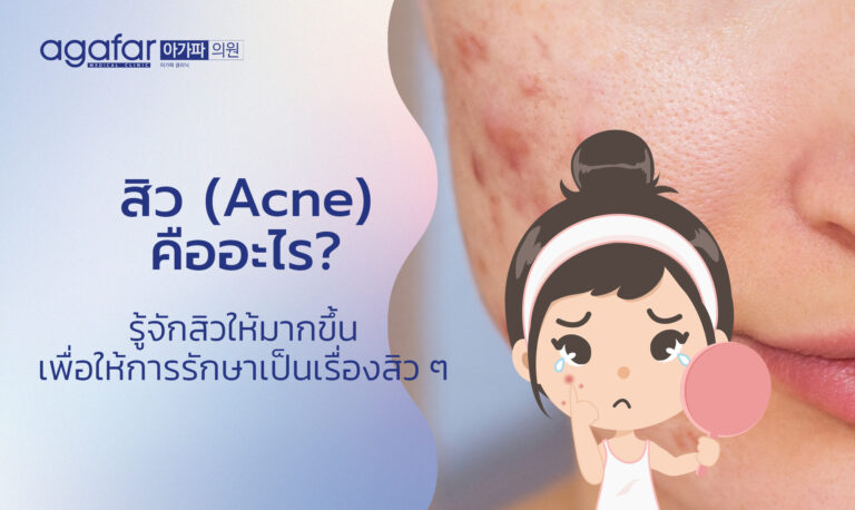 สิว (Acne) คืออะไร? รู้จักสิวให้มากขึ้น เกิดได้อย่างไร มีกี่ประเภท เพื่อให้การรักษาเป็นเรื่องสิว ๆ