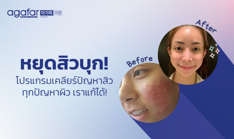 หยุดสิวบุก! โปรแกรมเคลียร์ปัญหาสิว จัดการได้ที่ agafar medical clinic