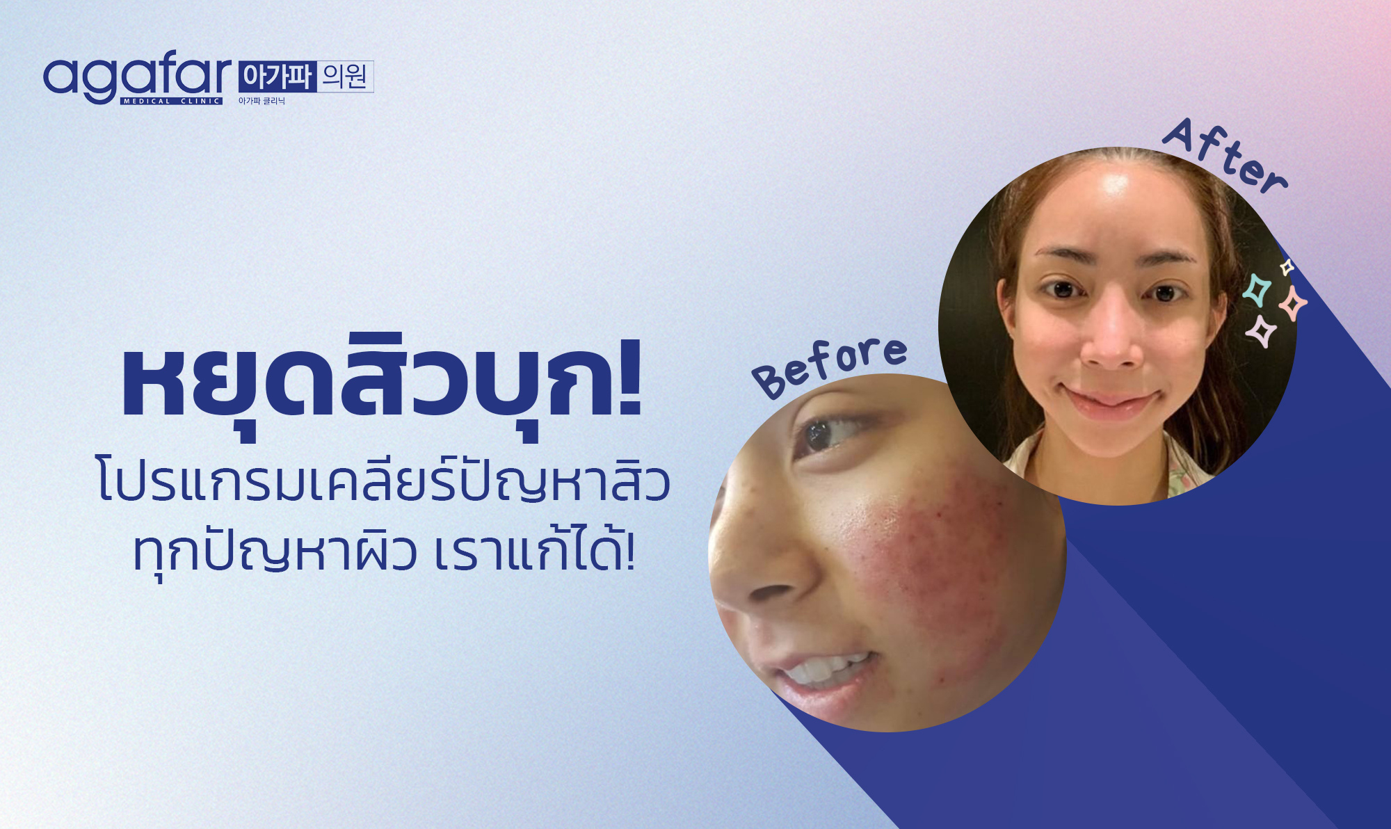 หยุดสิวบุก! โปรแกรมเคลียร์ปัญหาสิว จัดการได้ที่ agafar medical clinic